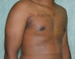 Gynecomastia (Puffy Nipples/ Male Chest Correction)