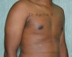 Gynecomastia (Puffy Nipples/ Male Chest Correction)