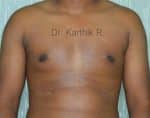 Gynecomastia (Puffy Nipples/ Male Chest Correction)