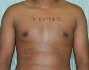 Gynecomastia (Puffy Nipples/ Male Chest Correction)