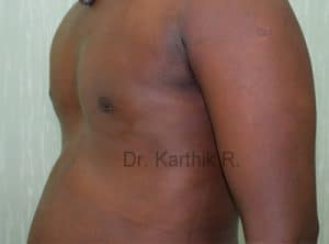 Gynecomastia (Puffy Nipples/ Male Chest Correction)