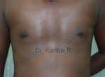 Gynecomastia (Puffy Nipples/ Male Chest Correction)