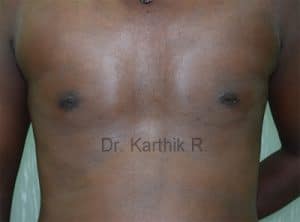Gynecomastia (Puffy Nipples/ Male Chest Correction)
