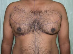 Gynecomastia (Puffy Nipples/ Male Chest Correction)