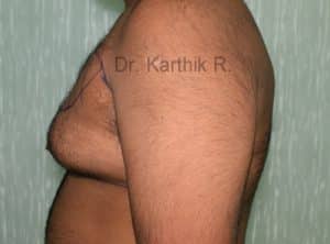 Gynecomastia (Puffy Nipples/ Male Chest Correction)