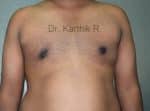 Gynecomastia (Puffy Nipples/ Male Chest Correction)