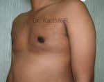 Gynecomastia (Puffy Nipples/ Male Chest Correction)