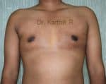 Gynecomastia (Puffy Nipples/ Male Chest Correction)