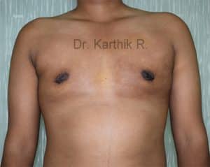 Gynecomastia (Puffy Nipples/ Male Chest Correction)