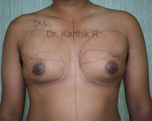 Gynecomastia (Puffy Nipples/ Male Chest Correction)