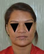 Rhinoplasty (Nose Corrections)