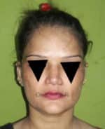 Rhinoplasty (Nose Corrections)