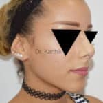 Rhinoplasty (Nose Corrections)