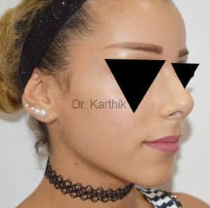 Rhinoplasty (Nose Corrections)