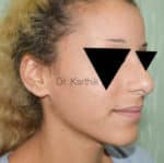 Rhinoplasty (Nose Corrections)