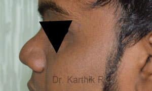 Rhinoplasty (Nose Corrections)