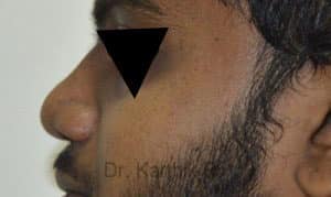 Rhinoplasty (Nose Corrections)