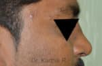 Rhinoplasty (Nose Corrections)
