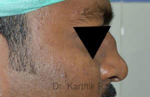 Rhinoplasty (Nose Corrections)