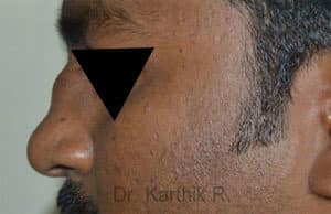 Rhinoplasty (Nose Corrections)