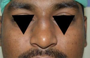 Rhinoplasty (Nose Corrections)