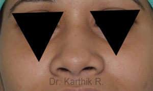 Rhinoplasty (Nose Corrections)