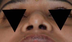 Rhinoplasty (Nose Corrections)