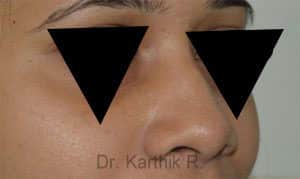 Rhinoplasty (Nose Corrections)