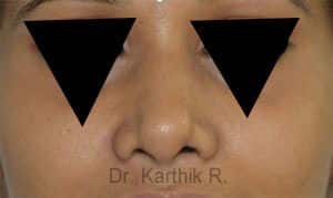 Rhinoplasty (Nose Corrections)