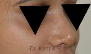 Rhinoplasty (Nose Corrections)