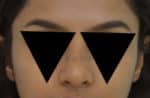 Rhinoplasty (Nose Corrections)
