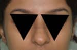 Rhinoplasty (Nose Corrections)