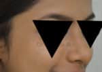 Rhinoplasty (Nose Corrections)