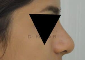 Rhinoplasty (Nose Corrections)