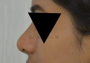 Rhinoplasty (Nose Corrections)