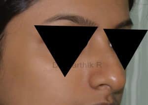 Rhinoplasty (Nose Corrections)