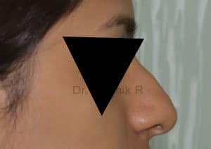 Rhinoplasty (Nose Corrections)