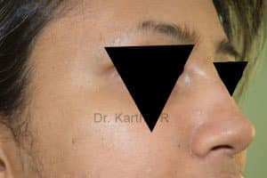 Rhinoplasty (Nose Corrections)