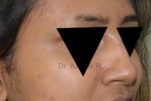 Rhinoplasty (Nose Corrections)