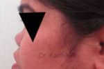 Rhinoplasty (Nose Corrections)