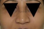 Rhinoplasty (Nose Corrections)
