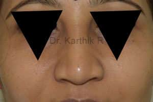 Rhinoplasty (Nose Corrections)