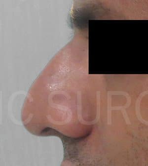 Rhinoplasty (Nose Corrections)