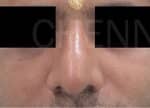 Rhinoplasty (Nose Corrections)