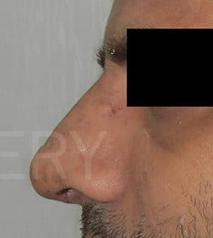 Rhinoplasty (Nose Corrections)