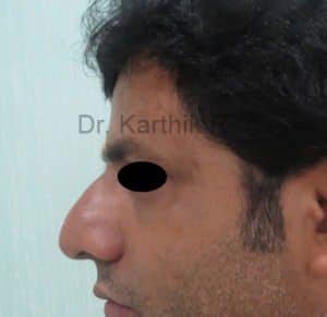 Rhinoplasty (Nose Corrections)