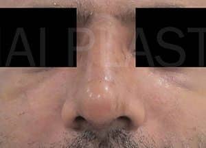 Rhinoplasty (Nose Corrections)