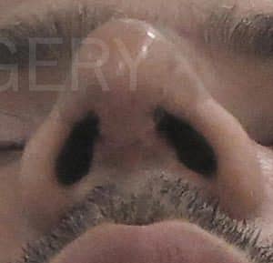 Rhinoplasty (Nose Corrections)