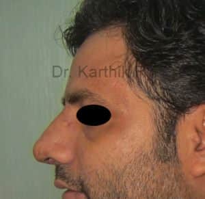 Rhinoplasty (Nose Corrections)