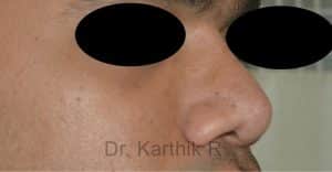 Rhinoplasty (Nose Corrections)